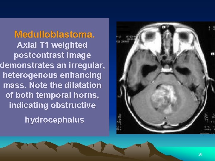 Medulloblastoma. Axial T 1 weighted postcontrast image demonstrates an irregular, heterogenous enhancing mass. Note