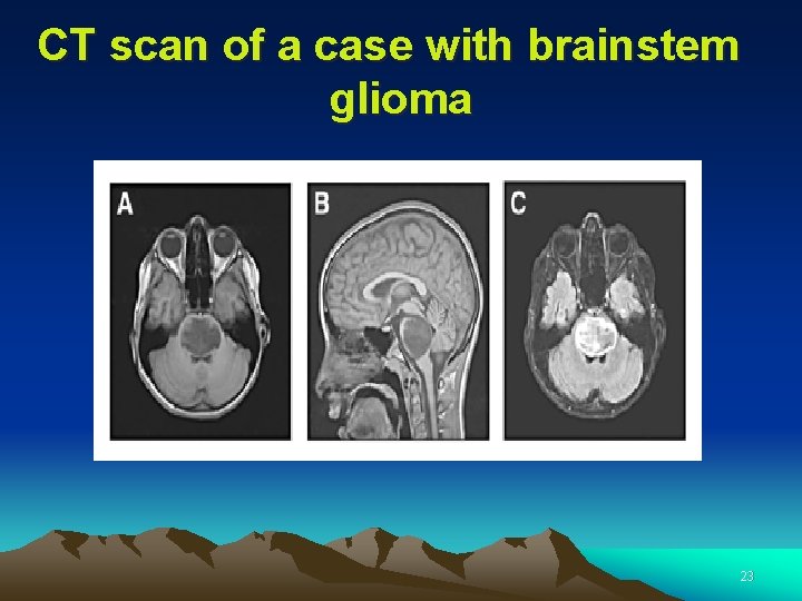 CT scan of a case with brainstem glioma 23 