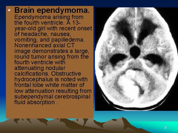  • Brain ependymoma. Ependymoma arising from the fourth ventricle. A 13 year-old girl