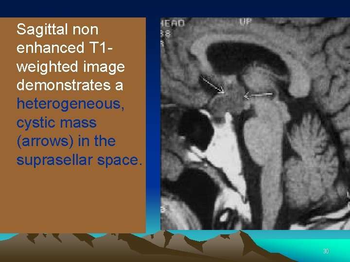 Sagittal non enhanced T 1 weighted image demonstrates a heterogeneous, cystic mass (arrows) in