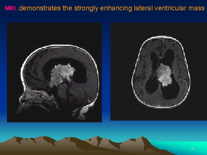 MRI. demonstrates the strongly enhancing lateral ventricular mass 33 