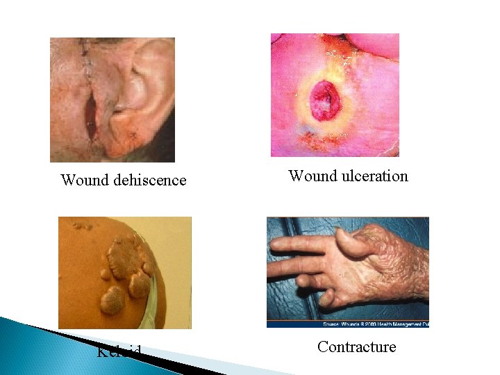 Wound dehiscence Keloid Wound ulceration Contracture 