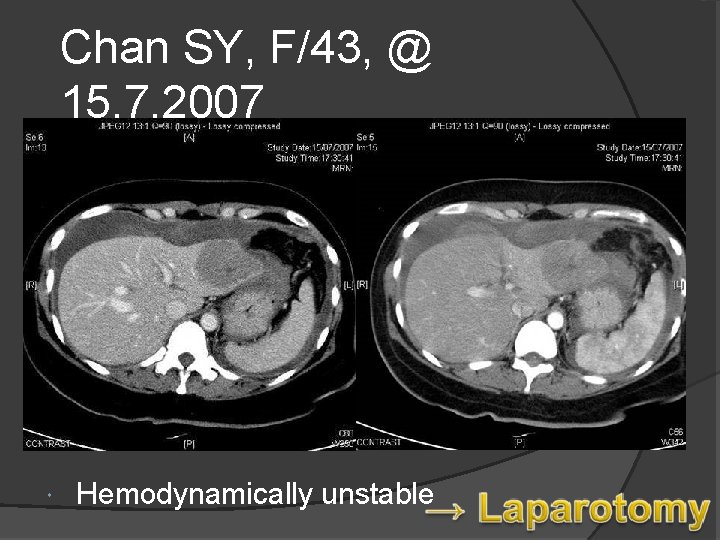 Chan SY, F/43, @ 15. 7. 2007 Known HBV carrier, L lobe liver mass