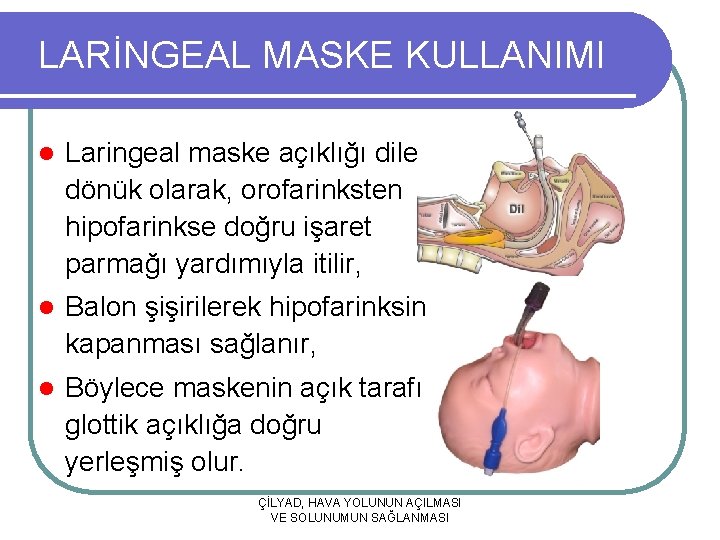 LARİNGEAL MASKE KULLANIMI l Laringeal maske açıklığı dile dönük olarak, orofarinksten hipofarinkse doğru işaret