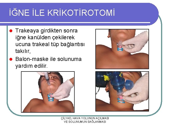 İĞNE İLE KRİKOTİROTOMİ Trakeaya girdikten sonra iğne kanülden çekilerek ucuna trakeal tüp bağlantısı takılır,