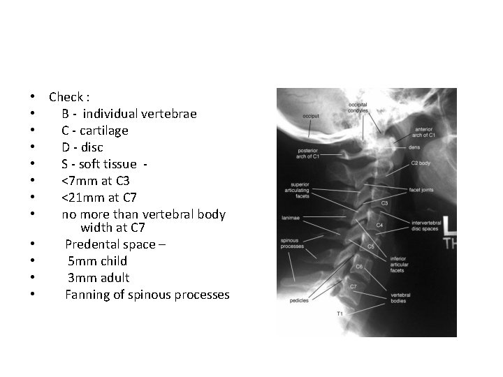  • Check : • B - individual vertebrae • C - cartilage •