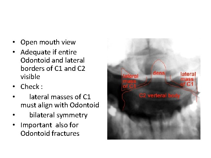  • Open mouth view • Adequate if entire Odontoid and lateral borders of