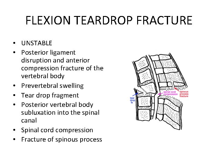 FLEXION TEARDROP FRACTURE • UNSTABLE • Posterior ligament disruption and anterior compression fracture of