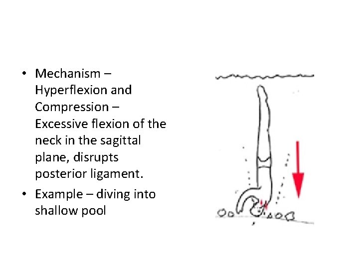  • Mechanism – Hyperflexion and Compression – Excessive flexion of the neck in