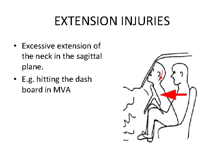 EXTENSION INJURIES • Excessive extension of the neck in the sagittal plane. • E.