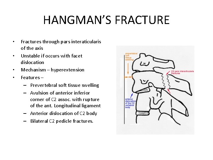 HANGMAN’S FRACTURE • • Fractures through pars interaticularis of the axis Unstable if occurs