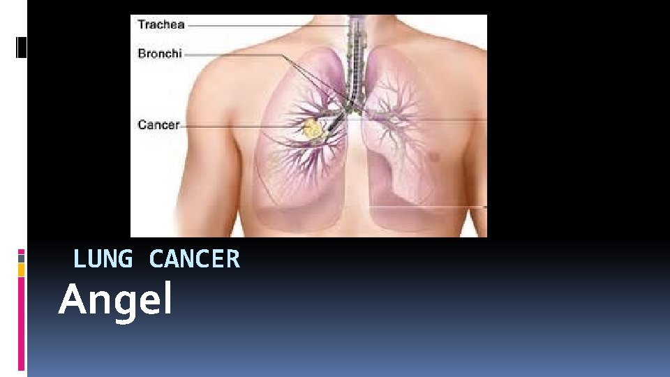 LUNG CANCER Angel 