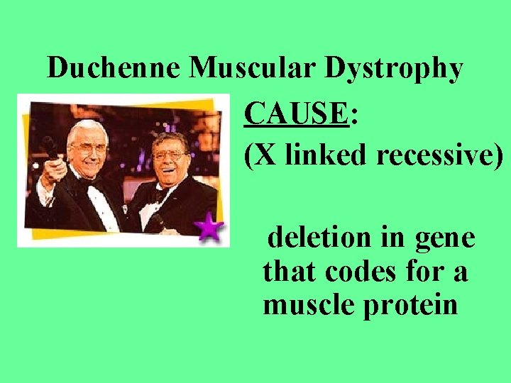 Duchenne Muscular Dystrophy CAUSE: (X linked recessive) deletion in gene that codes for a Duchenne Muscular Dystrophy CAUSE: (X linked recessive) deletion in gene that codes for a