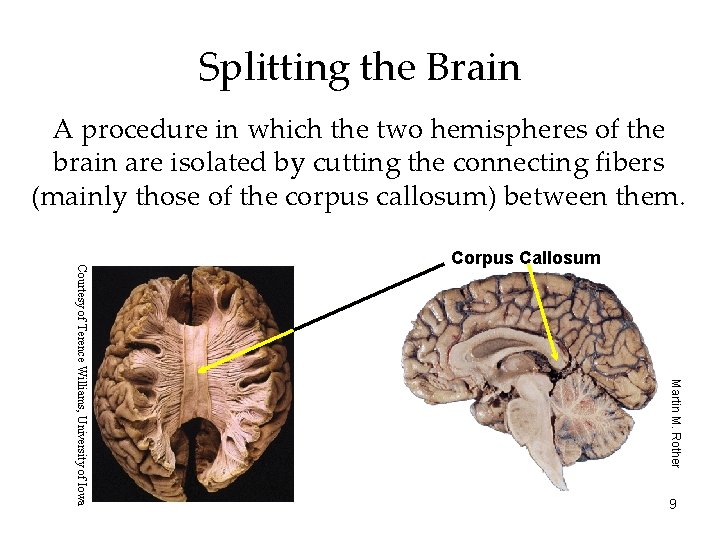 Splitting the Brain A procedure in which the two hemispheres of the brain are