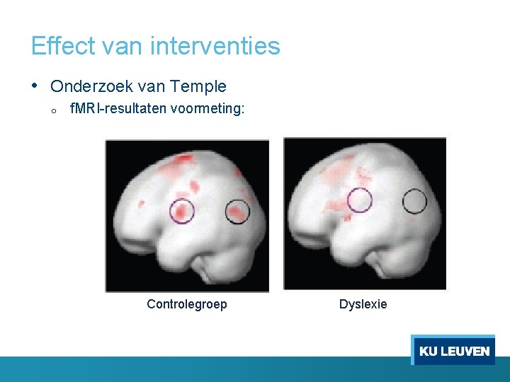 Effect van interventies • Onderzoek van Temple o f. MRI-resultaten voormeting: Controlegroep Dyslexie 