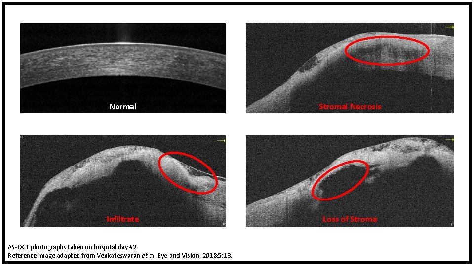 Normal Stromal Necrosis Infiltrate Loss of Stroma AS-OCT photographs taken on hospital day #2.