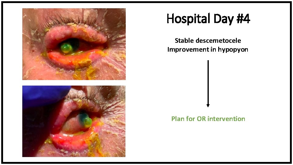 Hospital Day #4 Stable descemetocele Improvement in hypopyon Plan for OR intervention 