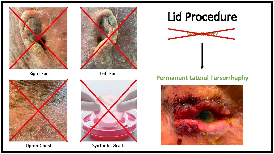 Lid Procedure Skin Graft? Right Ear Left Ear Upper Chest Synthetic Graft Permanent Lateral