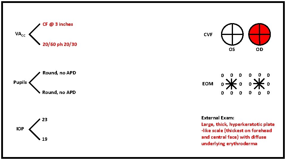 CF @ 3 inches VACC CVF 20/60 ph 20/30 OS Round, no APD Pupils