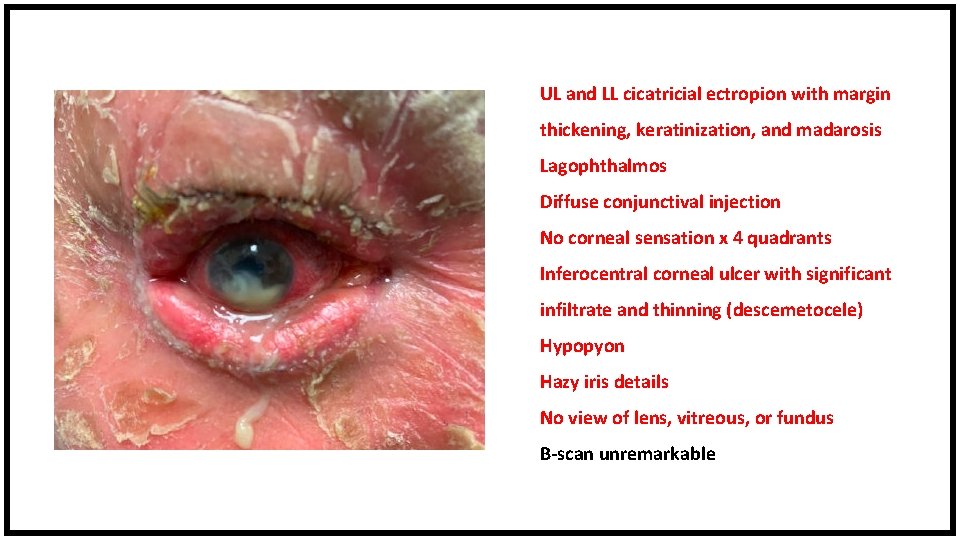 UL and LL cicatricial ectropion with margin thickening, keratinization, and madarosis Lagophthalmos Diffuse conjunctival