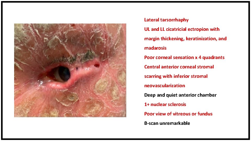 Lateral tarsorrhaphy UL and LL cicatricial ectropion with margin thickening, keratinization, and madarosis Poor