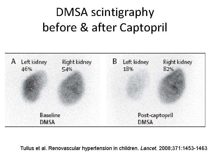 DMSA scintigraphy before & after Captopril Tullus et al. Renovascular hypertension in children. Lancet.