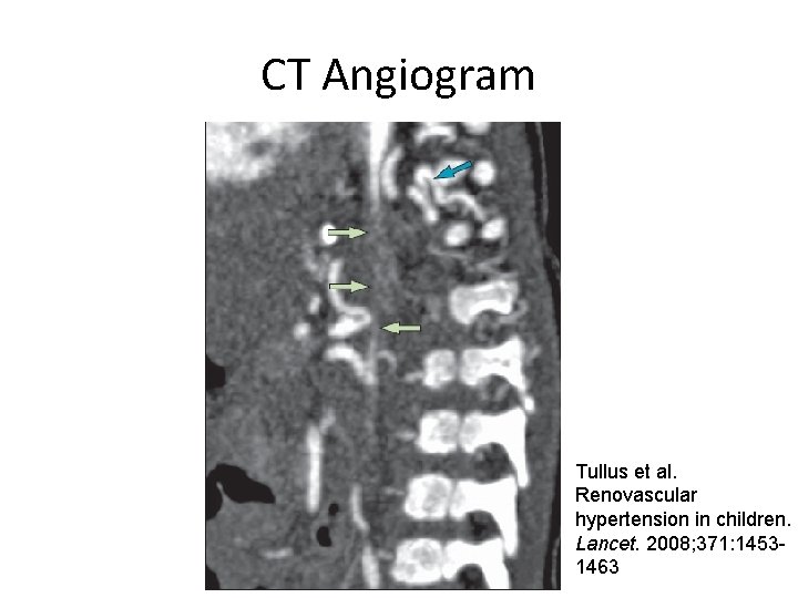 CT Angiogram Tullus et al. Renovascular hypertension in children. Lancet. 2008; 371: 14531463 