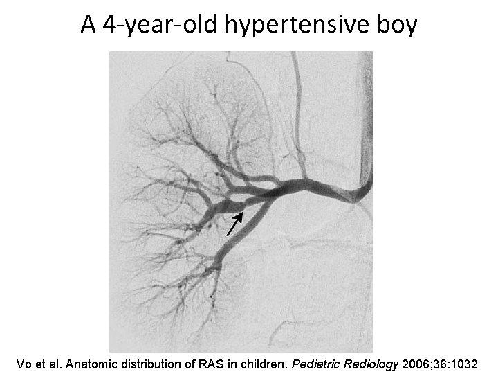 A 4 -year-old hypertensive boy Vo et al. Anatomic distribution of RAS in children.