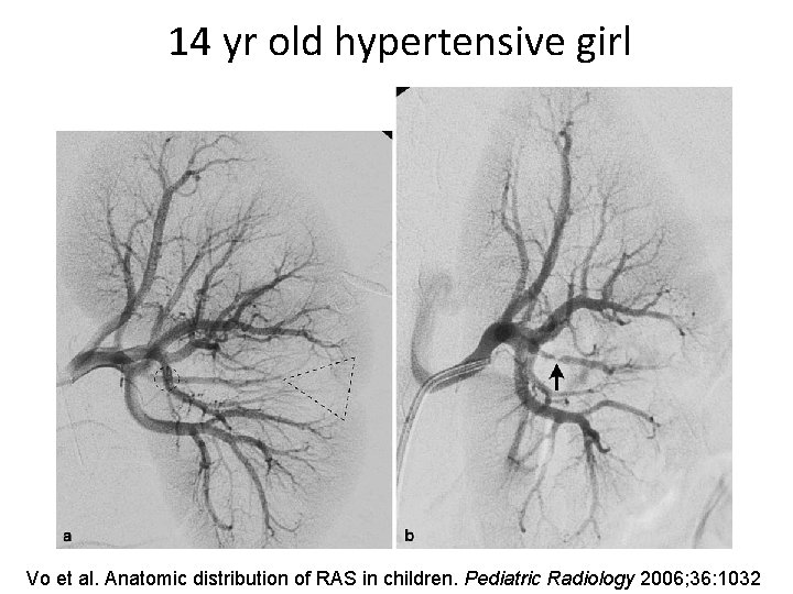 14 yr old hypertensive girl Vo et al. Anatomic distribution of RAS in children.