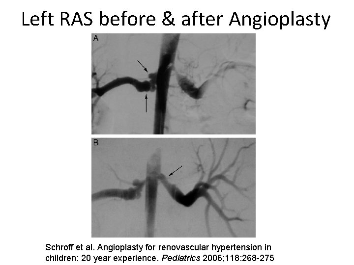 Left RAS before & after Angioplasty Schroff et al. Angioplasty for renovascular hypertension in