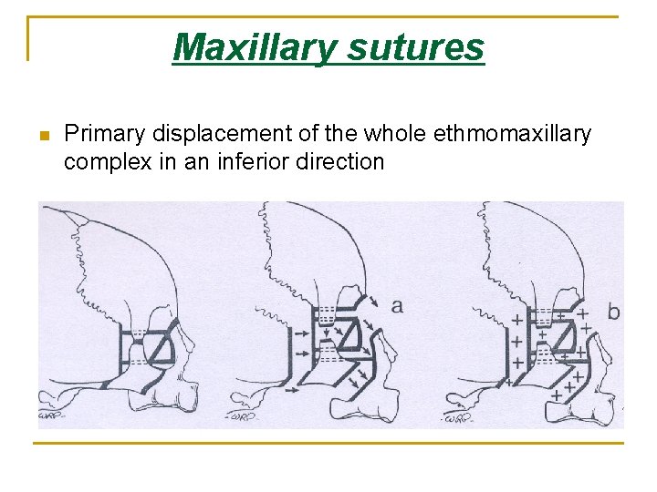 Maxillary sutures n Primary displacement of the whole ethmomaxillary complex in an inferior direction