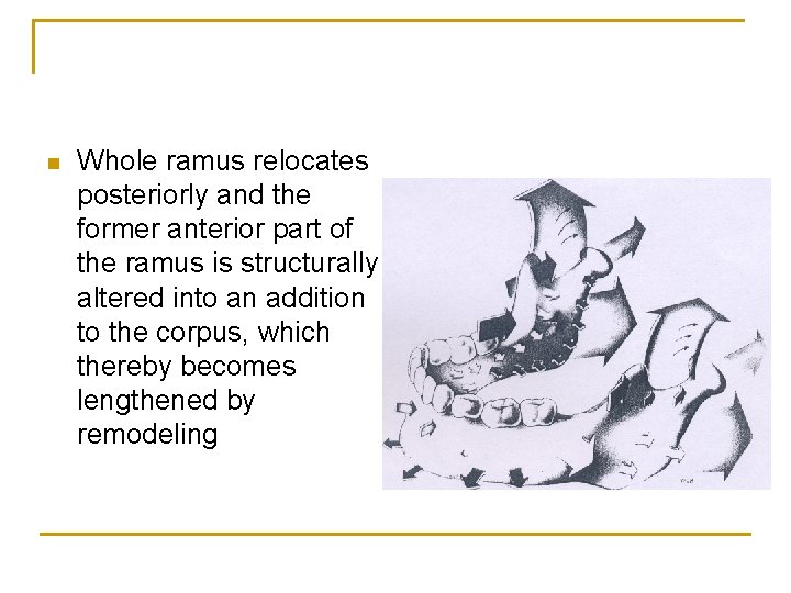 n Whole ramus relocates posteriorly and the former anterior part of the ramus is