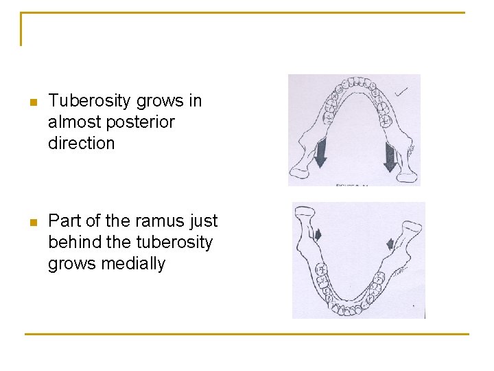 n Tuberosity grows in almost posterior direction n Part of the ramus just behind