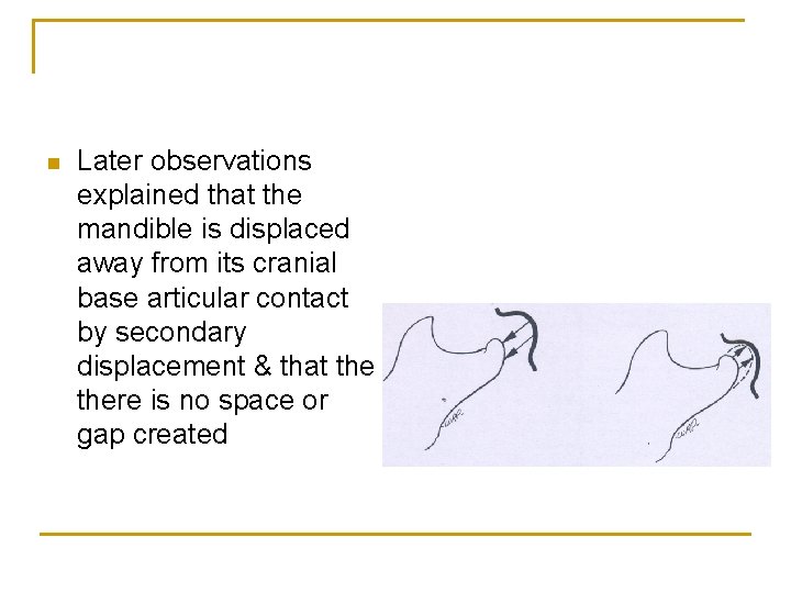 n Later observations explained that the mandible is displaced away from its cranial base