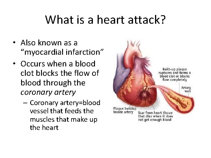 What is a heart attack? • Also known as a “myocardial infarction” • Occurs