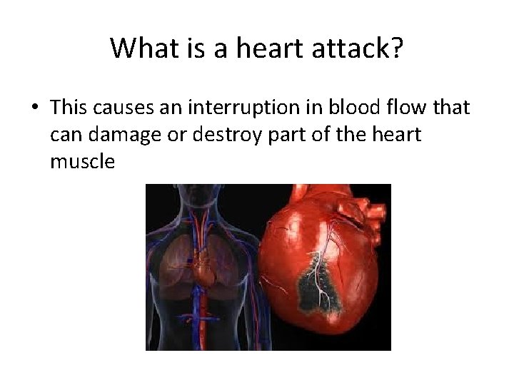 What is a heart attack? • This causes an interruption in blood flow that