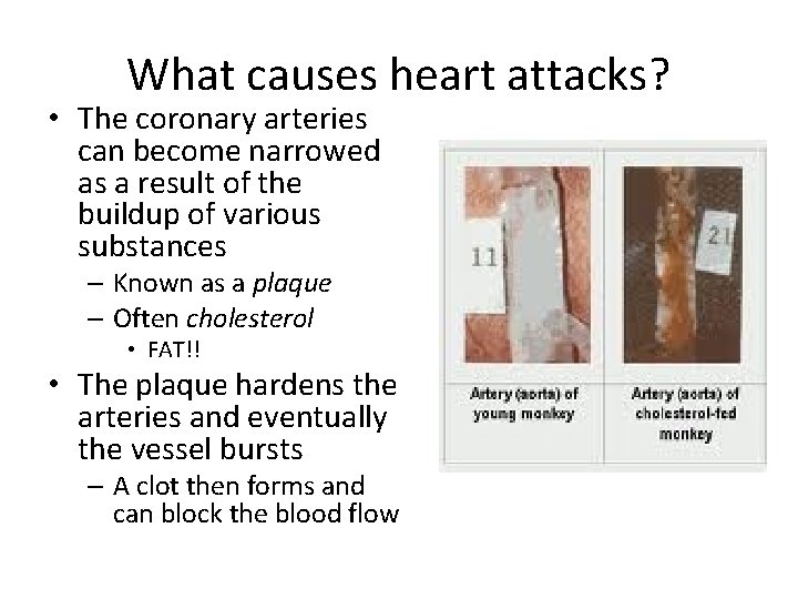 What causes heart attacks? • The coronary arteries can become narrowed as a result