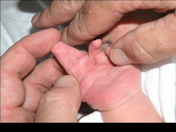 10 Hand of newborn infant showing complete syndactyly of two fingers. 