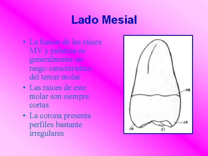 Lado Mesial • La fusión de las raíces MV y palatina es generalmente un