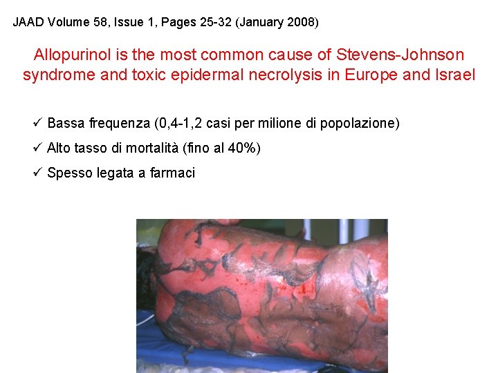 JAAD Volume 58, Issue 1, Pages 25 -32 (January 2008) Allopurinol is the most