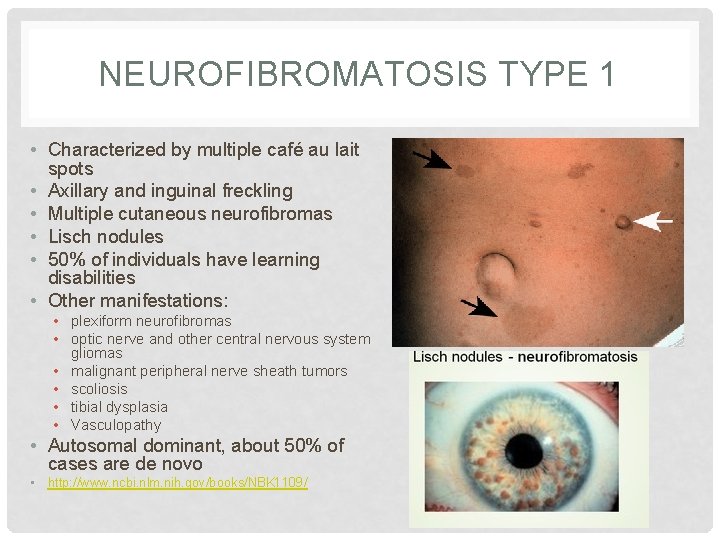 NEUROFIBROMATOSIS TYPE 1 • Characterized by multiple café au lait spots • Axillary and