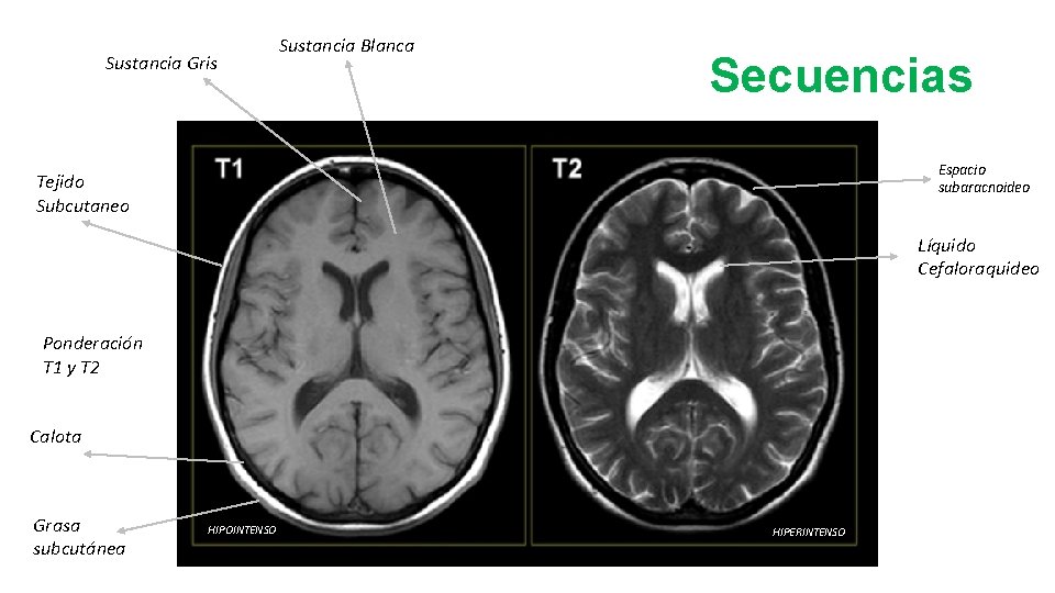 Sustancia Gris Sustancia Blanca Secuencias Espacio subaracnoideo Tejido Subcutaneo Líquido Cefaloraquideo Ponderación T 1