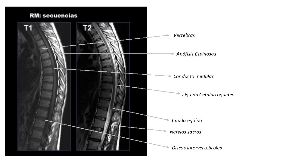 Vertebras Apófisis Espinosas Conducto medular Líquido Cefalorraquideo Cauda equina Nervios sacros Discos intervertebrales 