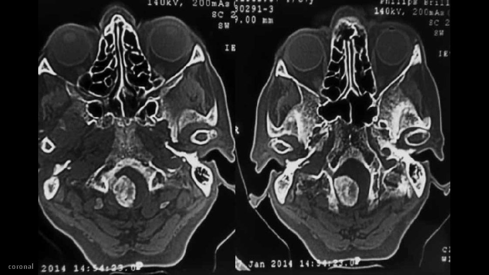 coronal 