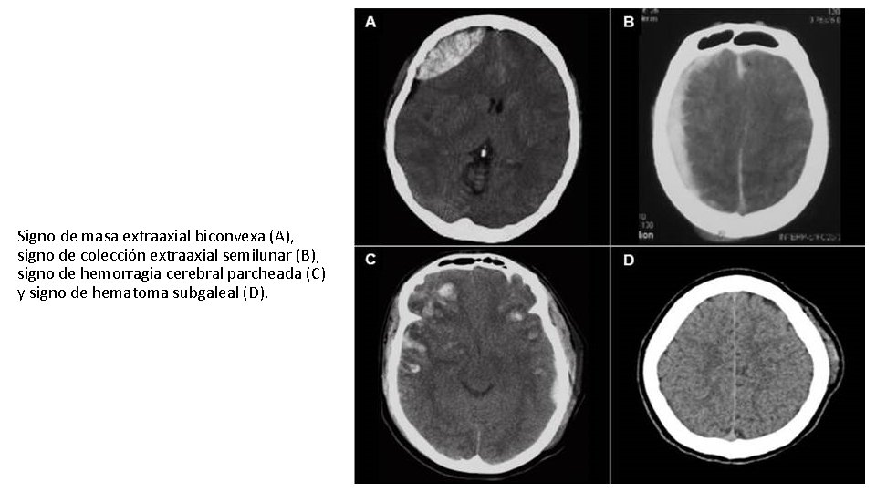 Signo de masa extraaxial biconvexa (A), signo de colección extraaxial semilunar (B), signo de