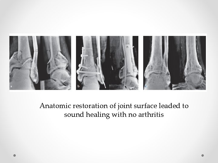 Anatomic restoration of joint surface leaded to sound healing with no arthritis 