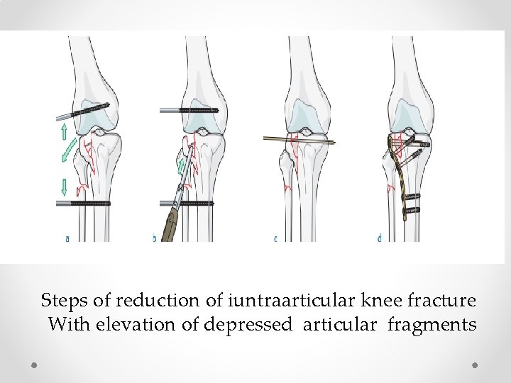 Steps of reduction of iuntraarticular knee fracture With elevation of depressed articular fragments 
