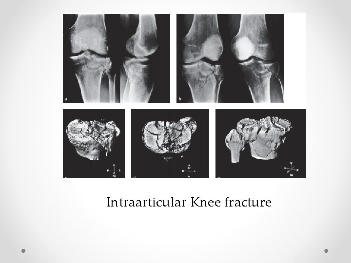 Intraarticular Knee fracture 