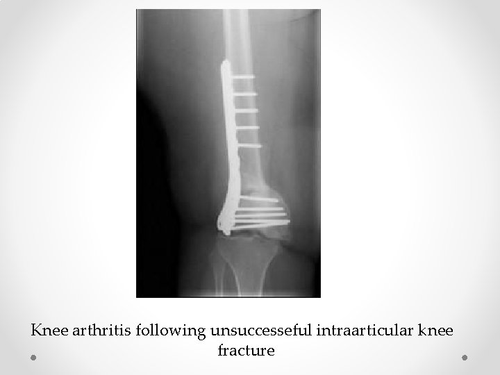 Knee arthritis following unsuccesseful intraarticular knee fracture 