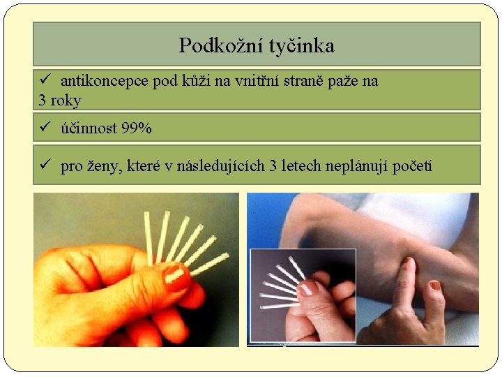 Podkožní tyčinka ü antikoncepce pod kůži na vnitřní straně paže na 3 roky ü